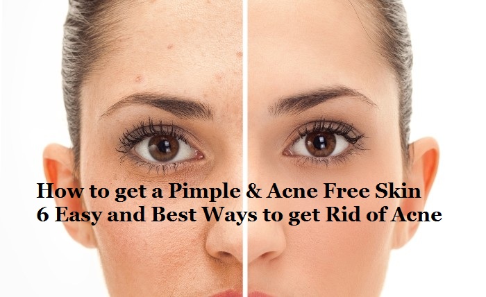 How to get Rid of Acne and Pimples – 6 Easy & Best Homemade Remedies to get Acne Free Skin -www.stylesgap