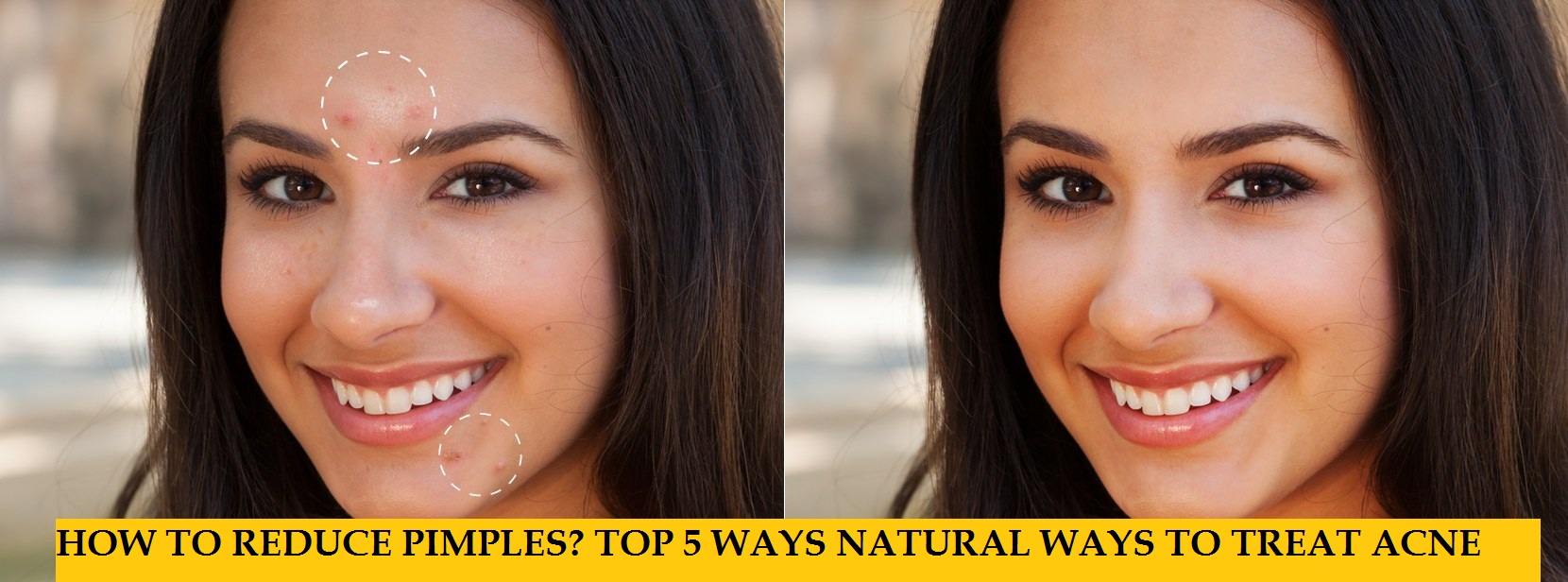 5 best ways to treat acne-pimples naturally