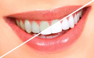 Teeth Bleaching Myths And Misperceptions You Must Know