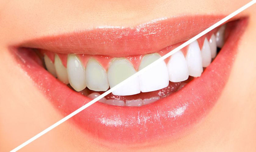 Teeth Bleaching Myths And Misperceptions (2)