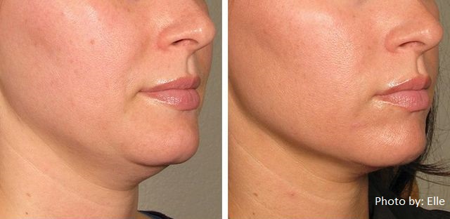 Cosmetic Laser treatment for Sagging Skin in Sagging Economy